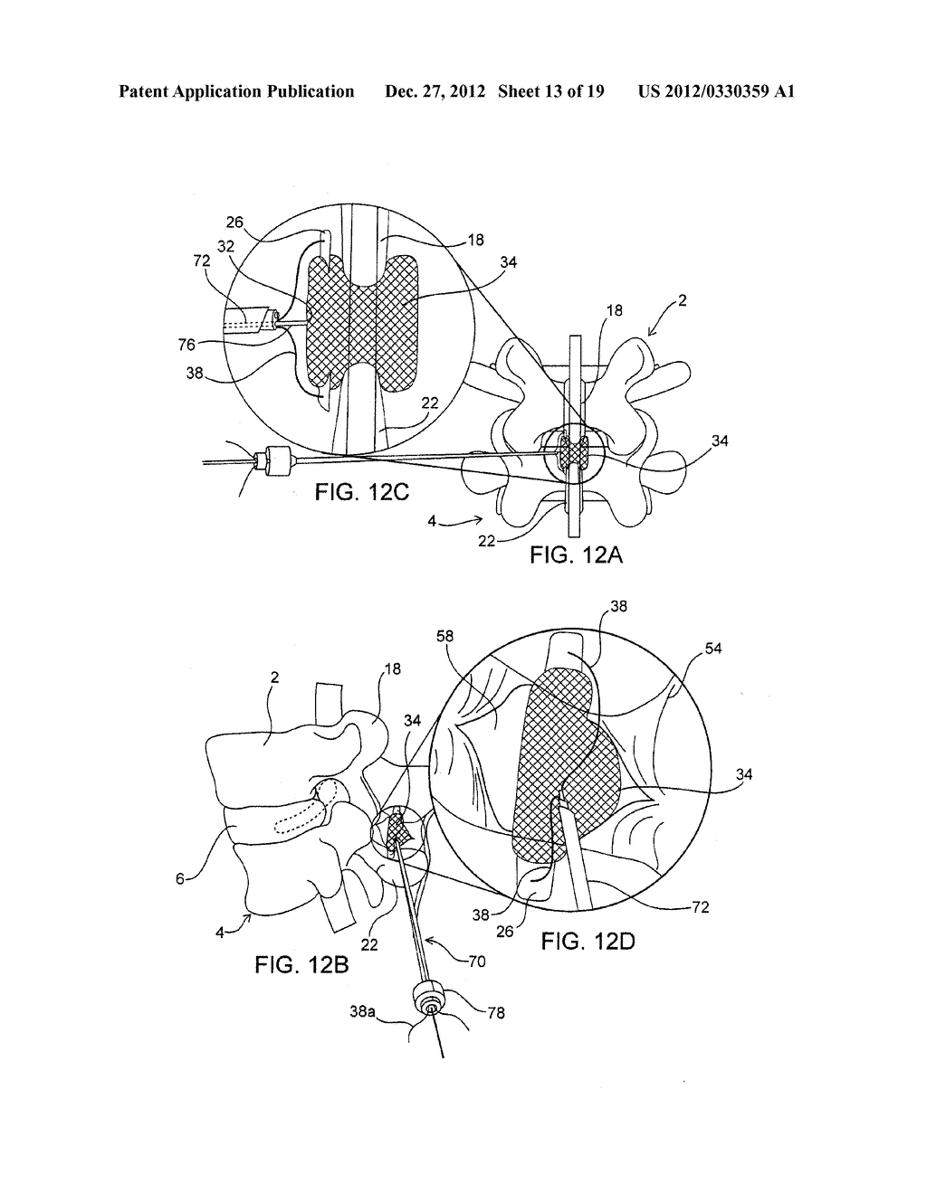 SYSTEMS AND METHODS FOR POSTERIOR DYNAMIC STABILIZATION OF THE SPINE - diagram, schematic, and image 14