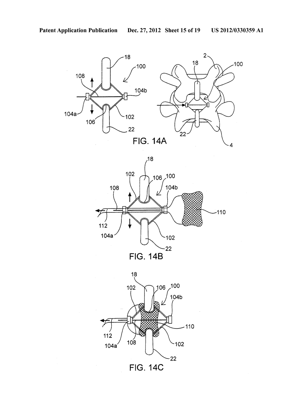 SYSTEMS AND METHODS FOR POSTERIOR DYNAMIC STABILIZATION OF THE SPINE - diagram, schematic, and image 16