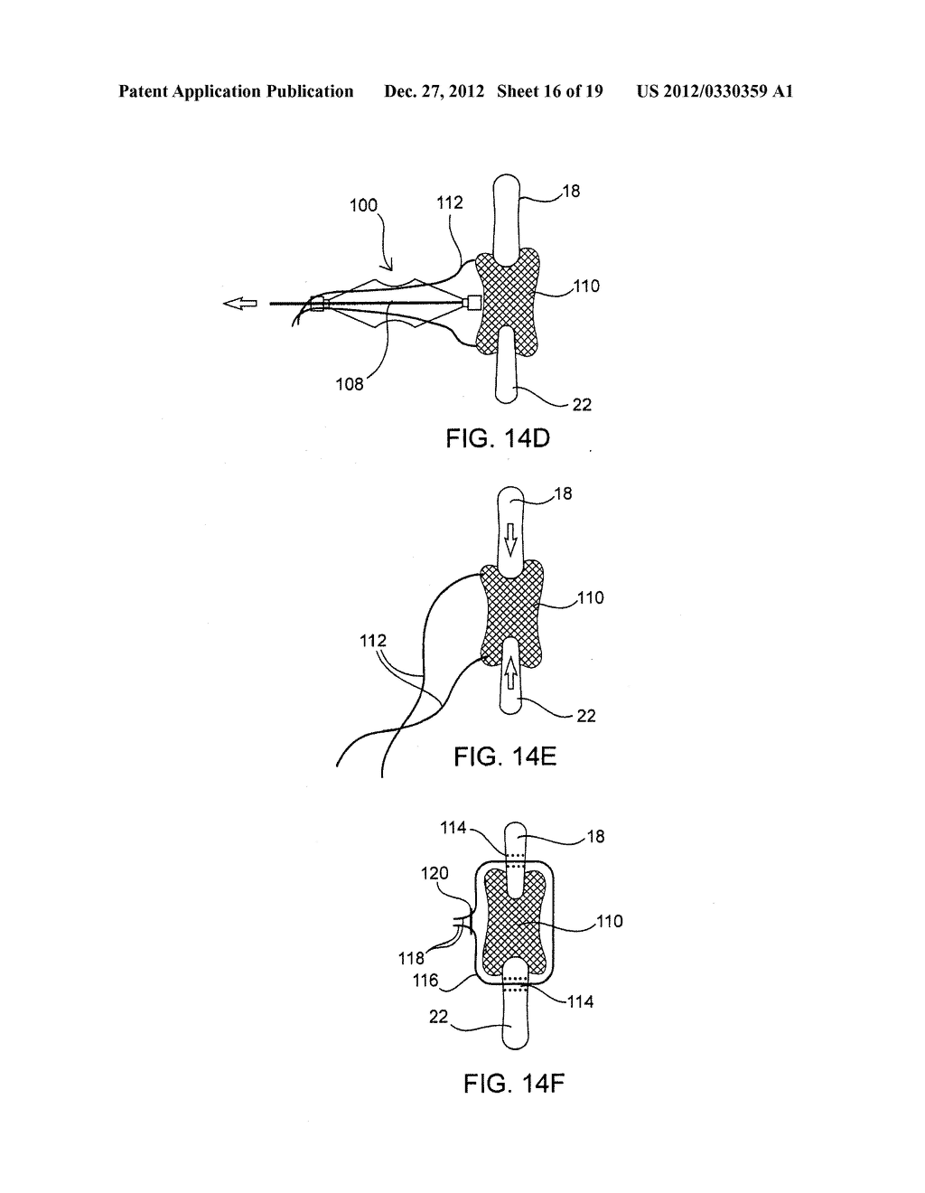 SYSTEMS AND METHODS FOR POSTERIOR DYNAMIC STABILIZATION OF THE SPINE - diagram, schematic, and image 17