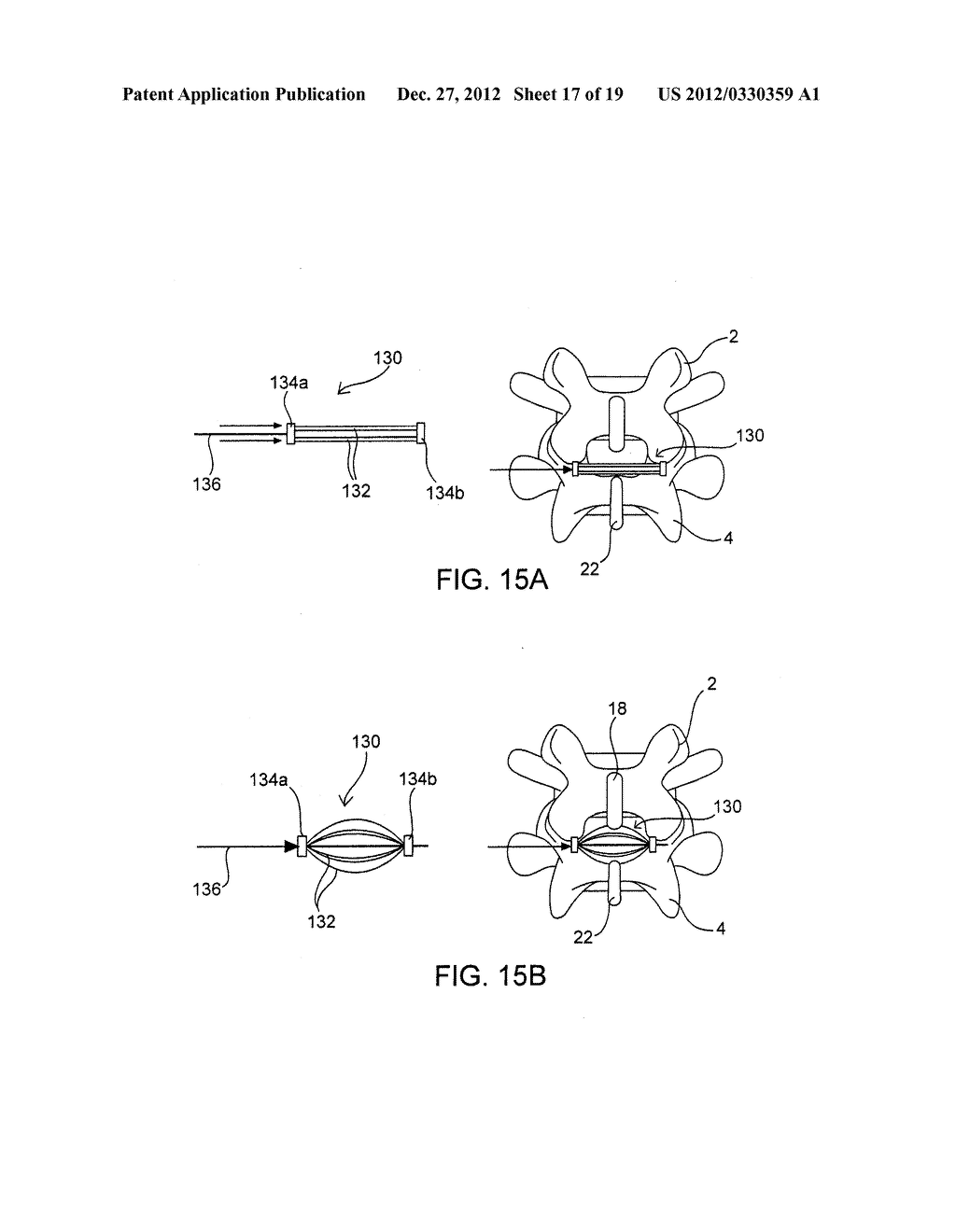 SYSTEMS AND METHODS FOR POSTERIOR DYNAMIC STABILIZATION OF THE SPINE - diagram, schematic, and image 18