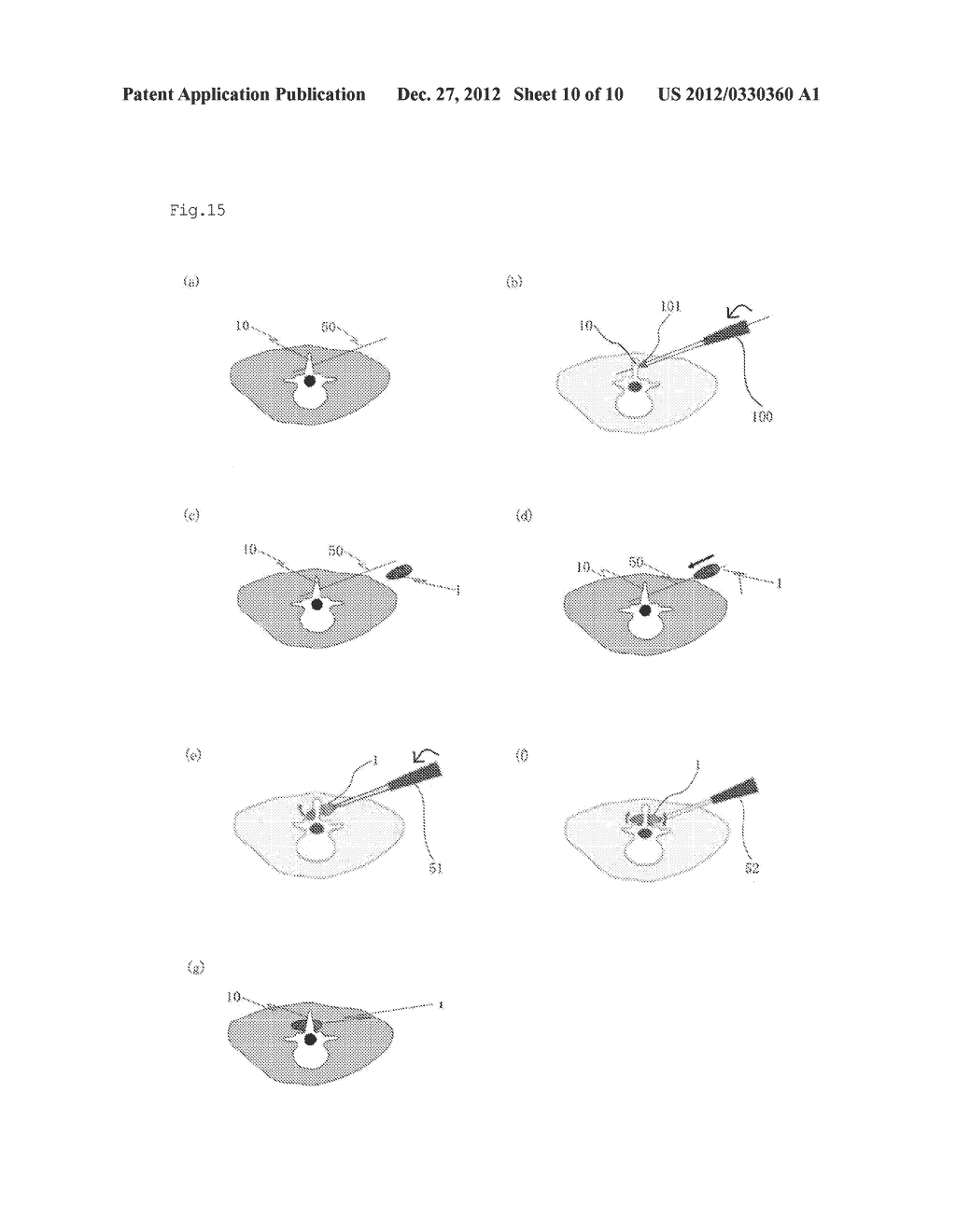 INTER-SPINOUS PROCESS IMPLANT - diagram, schematic, and image 11