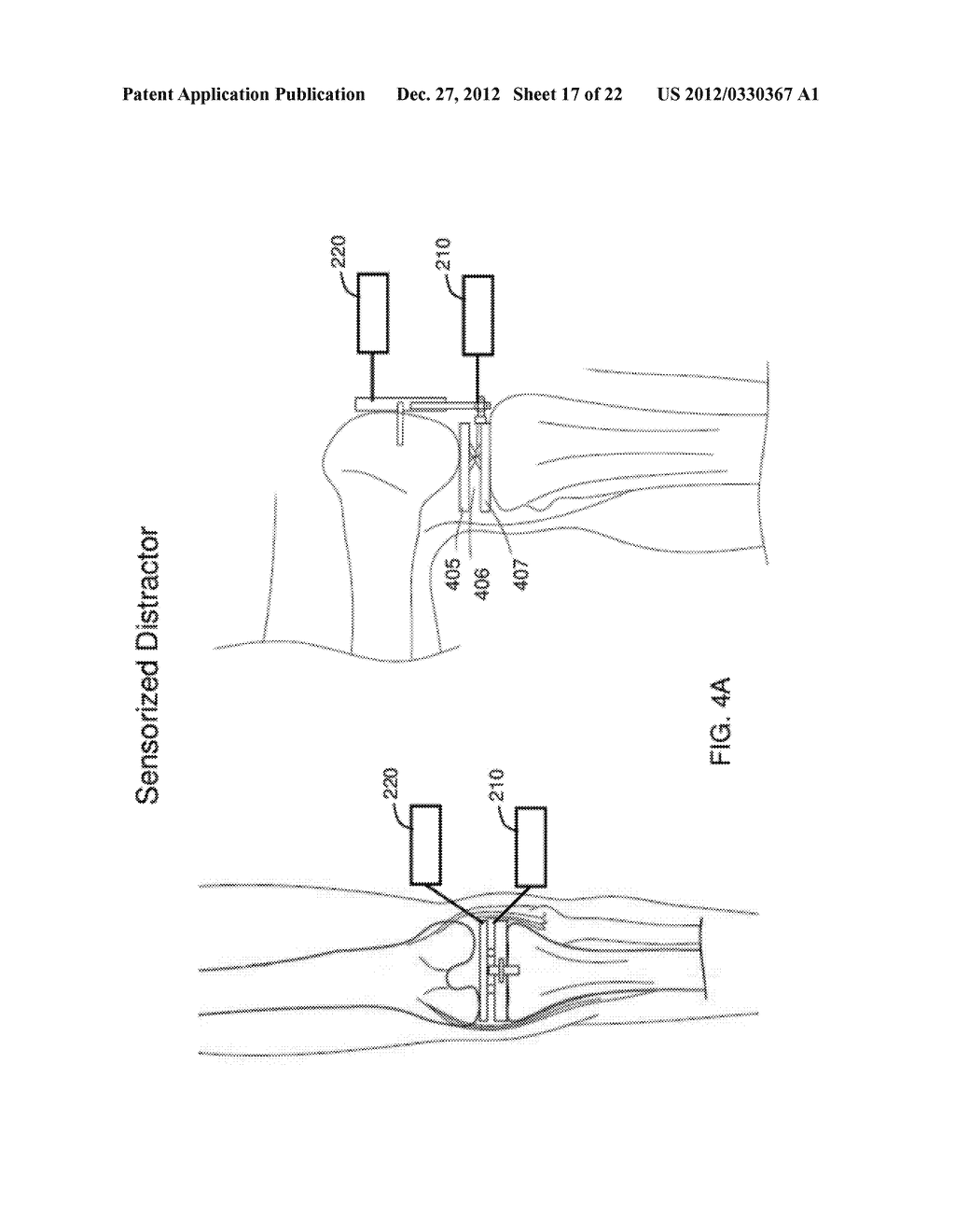 Orthopedic Check and Balance System - diagram, schematic, and image 18