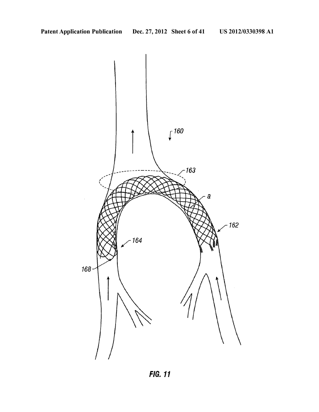 PLAIN WOVEN STENTS - diagram, schematic, and image 07