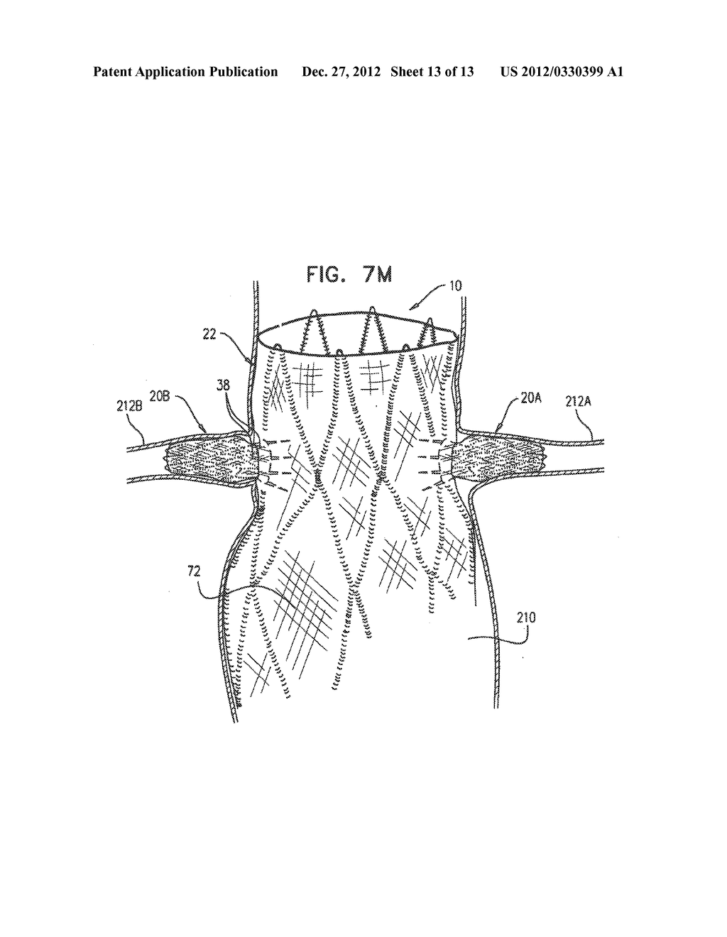 ENDOVASCULAR FENESTRATED STENT-GRAFTING - diagram, schematic, and image 14