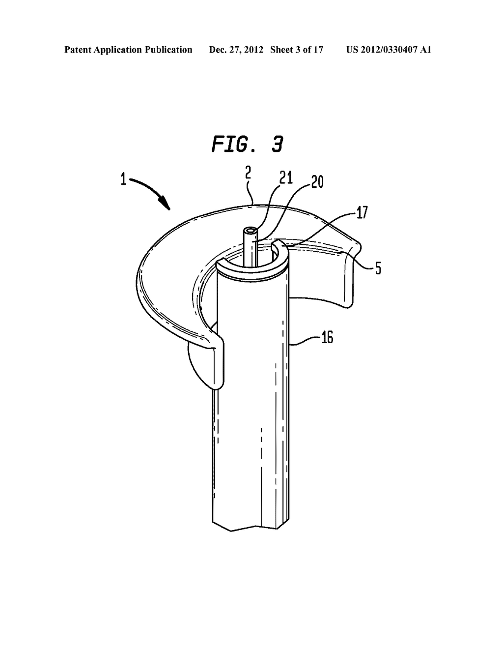 APPARATUS AND METHOD FOR HEART VALVE REPAIR - diagram, schematic, and image 04