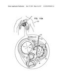 CLOSURE ELEMENT FOR USE WITH AN ANNULOPLASTY STRUCTURE diagram and image