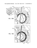 CLOSURE ELEMENT FOR USE WITH AN ANNULOPLASTY STRUCTURE diagram and image