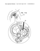 CLOSURE ELEMENT FOR USE WITH AN ANNULOPLASTY STRUCTURE diagram and image