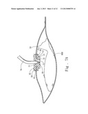 POUCH AIR VALVE AND STRUCTURE ADOPTED ON A SEALED POUCH AND METHOD OF USE diagram and image