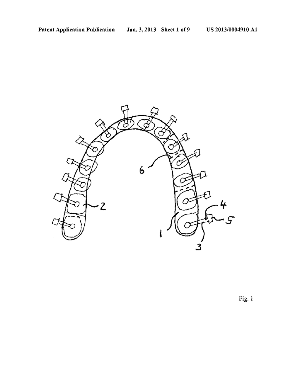 SYSTEM FOR POSITIONING ORTHODONTIC COMPONENTS - diagram, schematic, and image 02