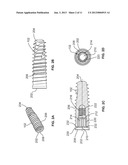 System and Method fo Dental Implant and Interface to Abutment For     Restoration diagram and image