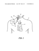 STRAIN RELIEF FEATURE FOR AN IMPLANTABLE MEDICAL DEVICE LEAD diagram and image