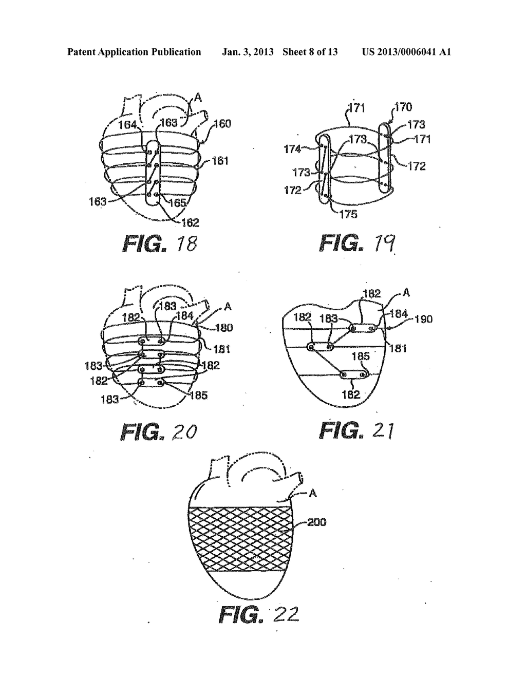 Heart Wall Tension Reduction Apparatus and Method - diagram, schematic, and image 09