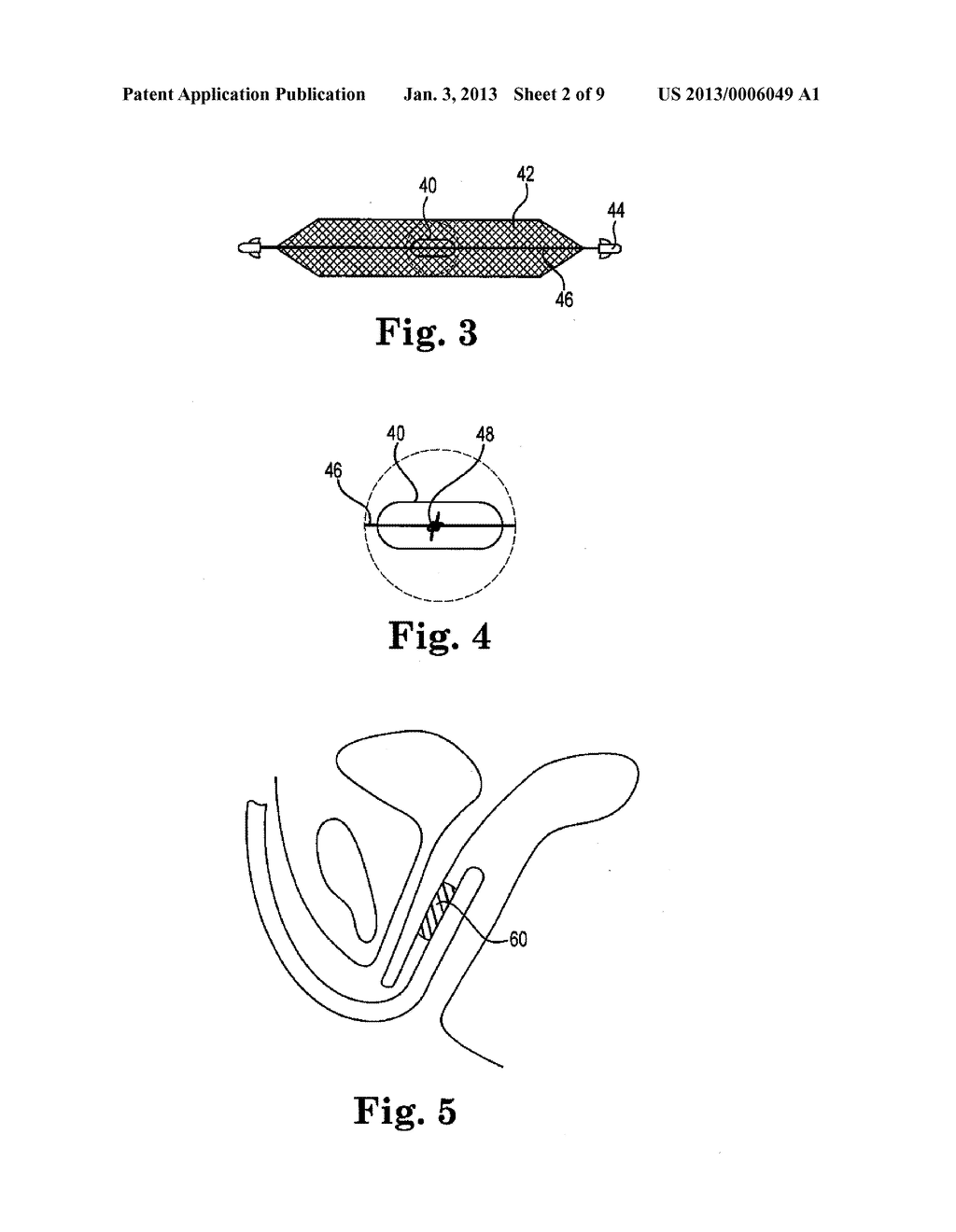 IMPLANTS, TOOLS, AND METHODS FOR TREATMENTS OF PELVIC CONDITIONS - diagram, schematic, and image 03