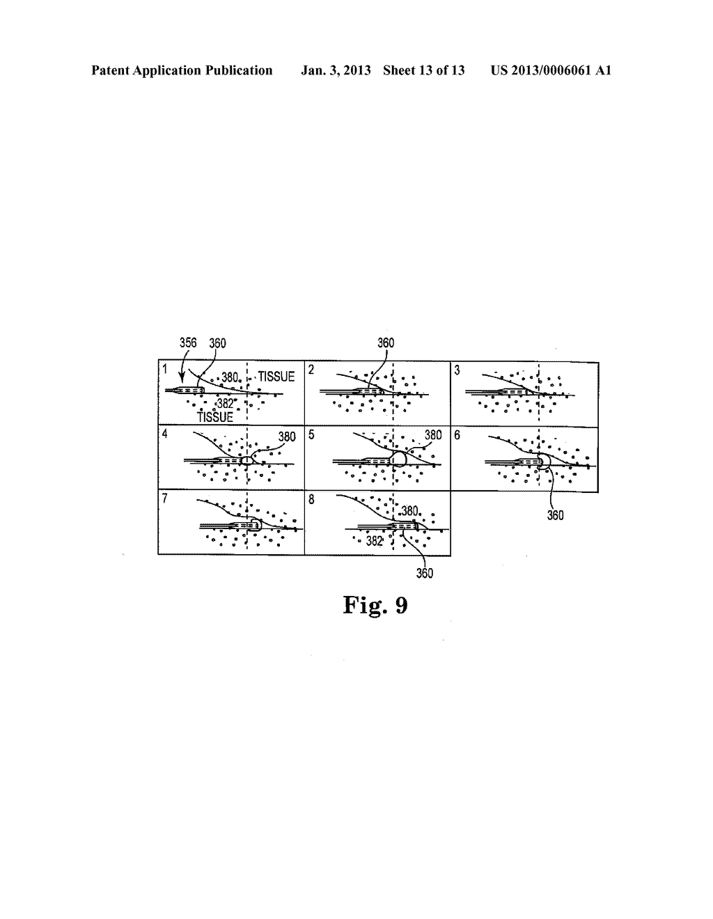 SYSTEMS, IMPLANTS, TOOLS, AND METHODS FOR TREATMENTS OF PELVIC CONDITIONS - diagram, schematic, and image 14