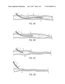 Endovascular Plasma Treatment Device and Method of Use diagram and image