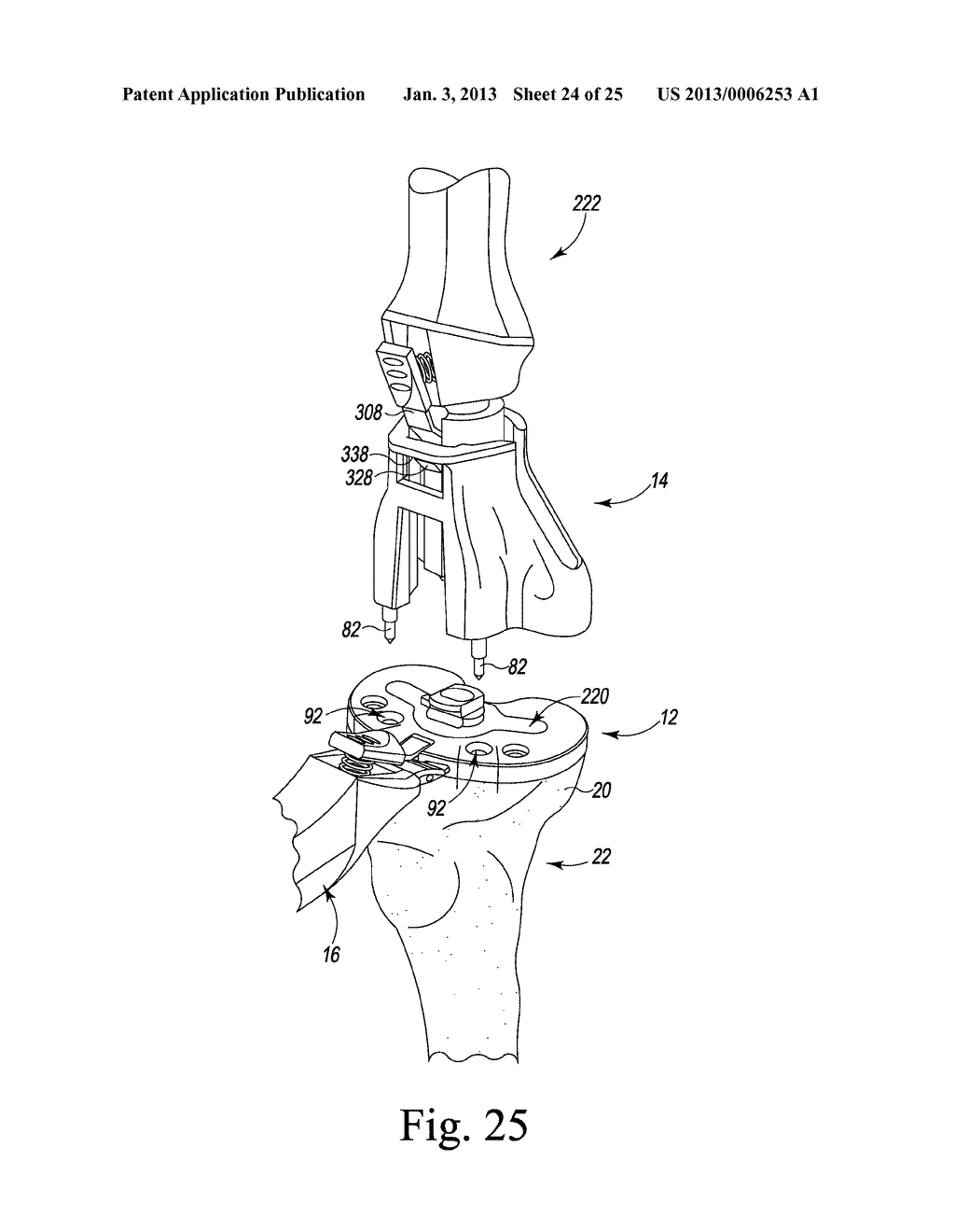 SURGICAL INSTRUMENT ASSEMBLIES FOR USE IN SURGICALLY PREPARING A TIBIA FOR     IMPLANTATION OF A PROSTHETIC COMPONENT - diagram, schematic, and image 25