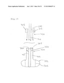 Large Vessel Closure Sheath diagram and image