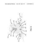 DEVICES, SYSTEMS, AND METHODS FOR INVERTING AND CLOSING THE LEFT ATRIAL     APPENDAGE diagram and image