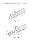 STENT POSITIONING SYSTEM AND METHOD diagram and image