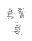 APPARATUS FOR ANTERIOR INTERVERTEBRAL SPINAL FIXATION AND FUSION diagram and image