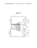 APPARATUS FOR ANTERIOR INTERVERTEBRAL SPINAL FIXATION AND FUSION diagram and image