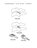 FACET JOINT IMPLANTS AND DELIVERY TOOLS diagram and image