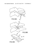 FACET JOINT IMPLANTS AND DELIVERY TOOLS diagram and image