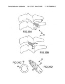 FACET JOINT IMPLANTS AND DELIVERY TOOLS diagram and image