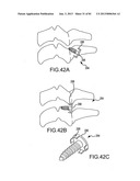 FACET JOINT IMPLANTS AND DELIVERY TOOLS diagram and image