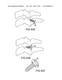 FACET JOINT IMPLANTS AND DELIVERY TOOLS diagram and image