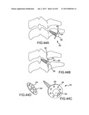 FACET JOINT IMPLANTS AND DELIVERY TOOLS diagram and image