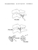 FACET JOINT IMPLANTS AND DELIVERY TOOLS diagram and image