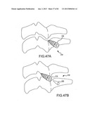 FACET JOINT IMPLANTS AND DELIVERY TOOLS diagram and image