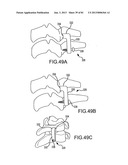 FACET JOINT IMPLANTS AND DELIVERY TOOLS diagram and image