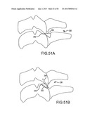 FACET JOINT IMPLANTS AND DELIVERY TOOLS diagram and image