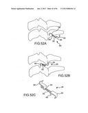 FACET JOINT IMPLANTS AND DELIVERY TOOLS diagram and image