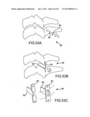 FACET JOINT IMPLANTS AND DELIVERY TOOLS diagram and image