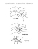 FACET JOINT IMPLANTS AND DELIVERY TOOLS diagram and image