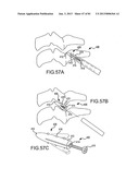 FACET JOINT IMPLANTS AND DELIVERY TOOLS diagram and image