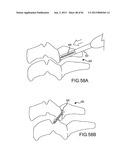 FACET JOINT IMPLANTS AND DELIVERY TOOLS diagram and image