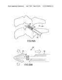 FACET JOINT IMPLANTS AND DELIVERY TOOLS diagram and image