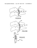 FACET JOINT IMPLANTS AND DELIVERY TOOLS diagram and image