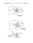 FACET JOINT IMPLANTS AND DELIVERY TOOLS diagram and image