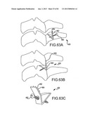 FACET JOINT IMPLANTS AND DELIVERY TOOLS diagram and image