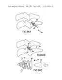 FACET JOINT IMPLANTS AND DELIVERY TOOLS diagram and image