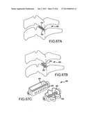 FACET JOINT IMPLANTS AND DELIVERY TOOLS diagram and image