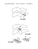 FACET JOINT IMPLANTS AND DELIVERY TOOLS diagram and image