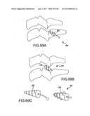 FACET JOINT IMPLANTS AND DELIVERY TOOLS diagram and image