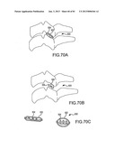 FACET JOINT IMPLANTS AND DELIVERY TOOLS diagram and image